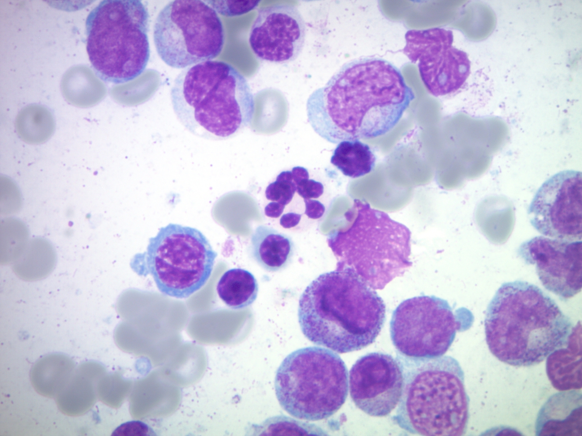 Marrow aspirate showing atypical neutrophil and numerous maturing precursors